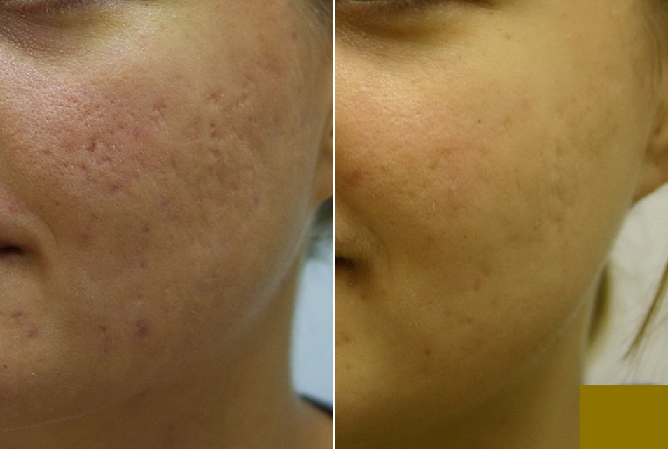 Ožiljak na licu prije i poslije uklanjaja laserom