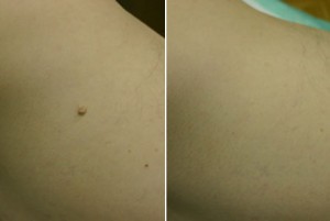 Fibrom prije - poslje