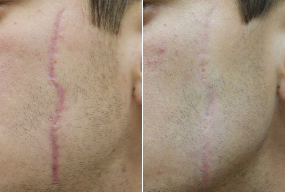 Ožiljak na licu prije i poslije uklanjaja laserom