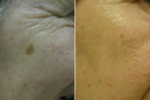 Pigmentacija prije - poslje