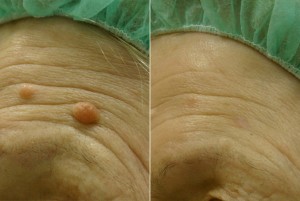 Madež prije tretmana i dva mjeseca nakon tretmana