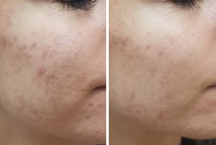 Akne na licu prije i mjesec nakon tretmana laserom